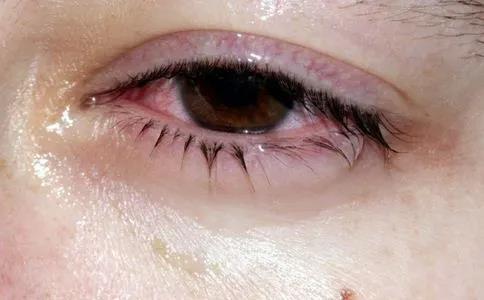 眼睛發(fā)癢難忍，竟是因為它